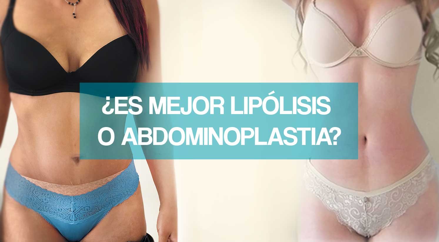 ¿Es mejor lipólisis o abdominoplastia?