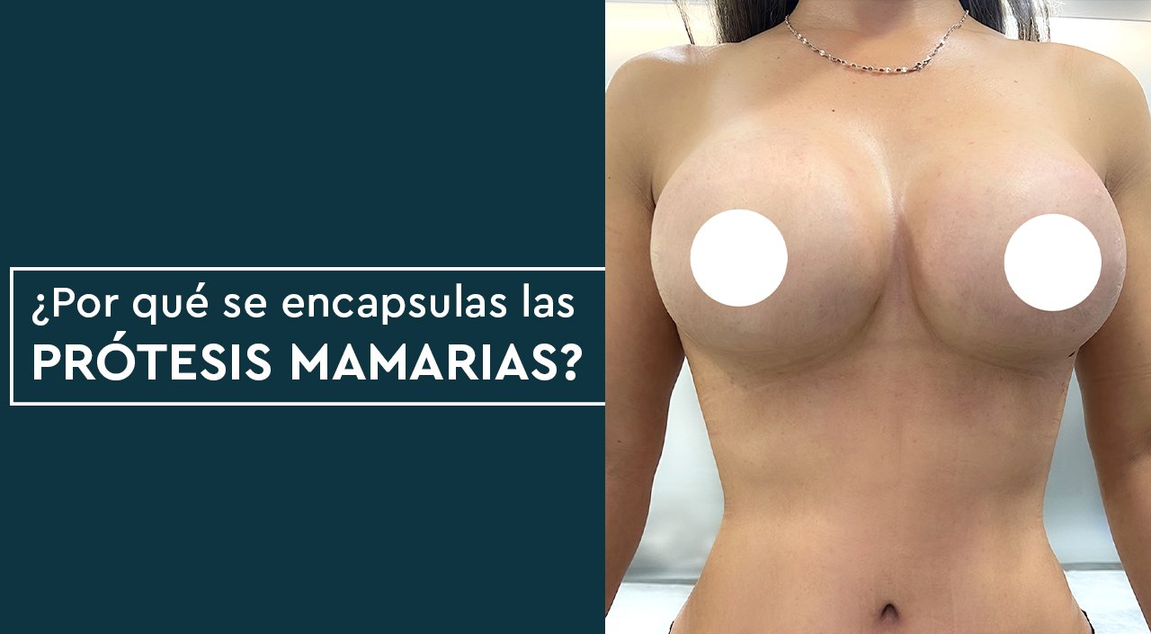 ¿POR QUÉ SE ENCAPSULAN LAS PRÓTESIS MAMARIAS?