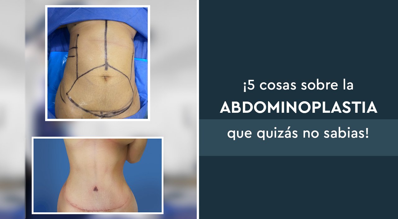 Abdominoplastia, Cirugía del Abdomen