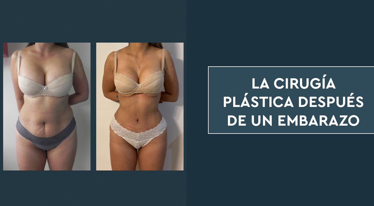 La Cirugía Plástica después de un embarazo