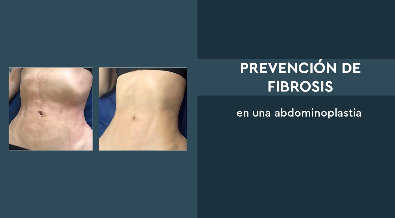 Prevención de fibrosis en una abdominoplastia