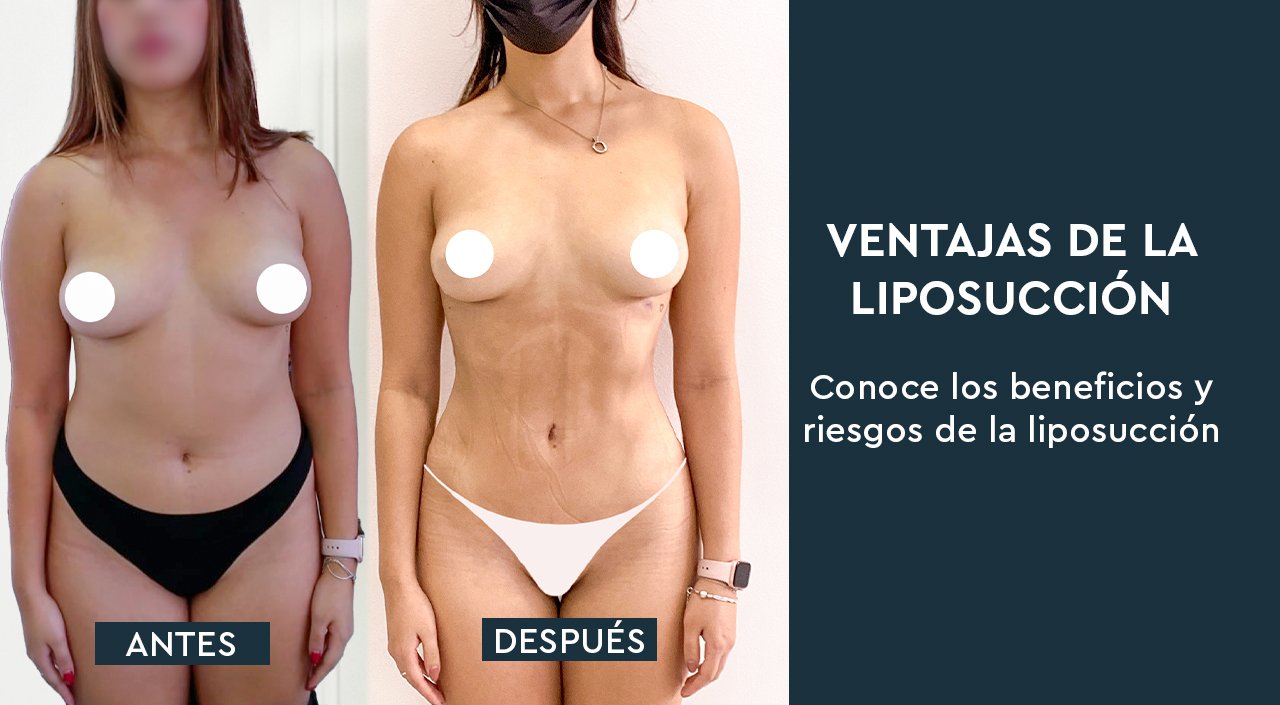 4 Ventajas de la liposucción – Beneficios y riesgos